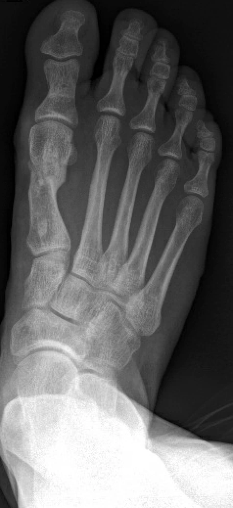 Radiografía postoperatoria del pie derecho tras la corrección del hallux valgus