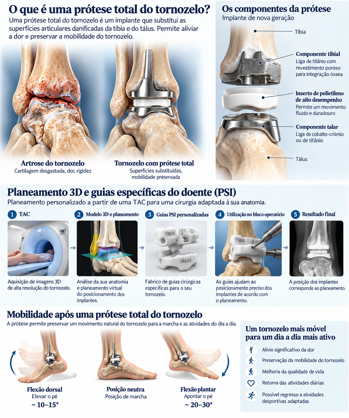 Infográfico explicativo sobre a prótese total do tornozelo, os seus componentes e o planeamento PSI
